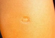 Svi rođeni u Jugoslaviji imaju ovaj ožiljak na ruci: Znate li kako je nastao i zbog čega? Svi su iznenađeni