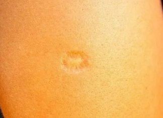 Svi rođeni u Jugoslaviji imaju ovaj ožiljak na ruci: Znate li kako je nastao i zbog čega? Svi su iznenađeni