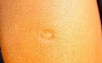 Svi rođeni u Jugoslaviji imaju ovaj ožiljak na ruci: Znate li kako je nastao i zbog čega? Svi su iznenađeni