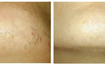 IMATE LI JEDNU UPORNU DLAČICU NA BRADI? Evo šta to znači! Nije se pojavila bez razloga