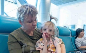 Jelena rodila dete bez pola lica, onesvestila se od šoka kad je videla: Svi su iznenađeni kako sad ova devojčica izgleda