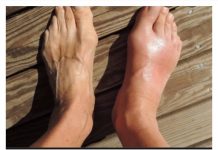 Uklonite mokraćnu kiselinu iz tijela: ova 3 narodna lijeka dokazano su učinkovita u liječenju gihta (recepti)