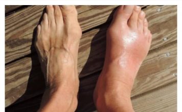 Uklonite mokraćnu kiselinu iz tijela: ova 3 narodna lijeka dokazano su učinkovita u liječenju gihta (recepti)