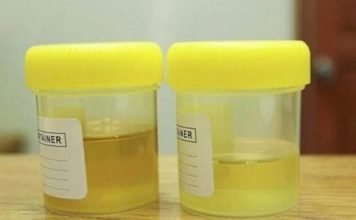 Osjetite li jak miris urina kada ustanete sa sjedišta? To nije infekcija urinarnog trakta, već mnogo opasnije stanje koje vas muči!