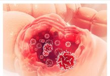 Ako osjetite ovaj početni znak RAKA CRIJEVA, koji se ne smije zamijeniti s hemoroidima, ključno je odmah potražiti liječničku pomoć bez osjećaja srama