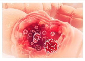 Ako osjetite ovaj početni znak RAKA CRIJEVA, koji se ne smije zamijeniti s hemoroidima, ključno je odmah potražiti liječničku pomoć bez osjećaja srama