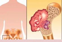 Ako osjetite bolove u kostima, visoki krvni tlak i osjećaj tuge, to može ukazivati na nedostatak ovog ključnog vitamina