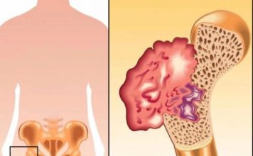Ako osjetite bolove u kostima, visoki krvni tlak i osjećaj tuge, to može ukazivati na nedostatak ovog ključnog vitamina