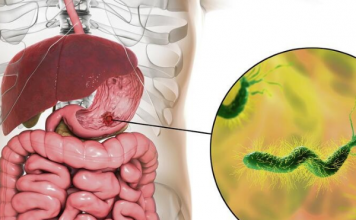 Ova bakterija je najveći neprijatelj želuca: Lako se zarazite, a posledice mogu biti opasne – obratite pažnju na 1 stvar