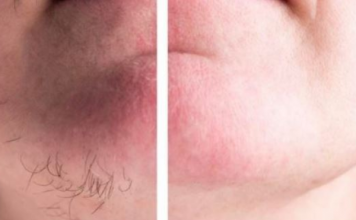 DLAČICE S LICA nestaju kao rukom odnesene:Sve žene širom svijeta potpuno su poludile za ovim receptom!