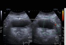 RAK BUBREGA IMA 6 SIMPTOMA – TEŠKO SE PREPOZNAJU: Posebno obratite pažnju na broj 2