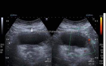 RAK BUBREGA IMA 6 SIMPTOMA – TEŠKO SE PREPOZNAJU: Posebno obratite pažnju na broj 2