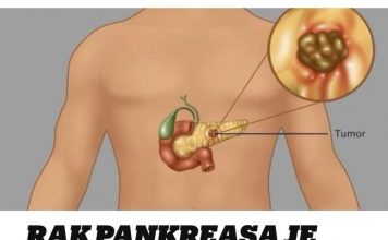 Rak gušterače je tihi ubojica. Stručnjaci podsjećaju da obratite pozornost na pet glavnih simptoma