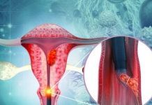 5 SIMPTOMA RAKA GRLIĆA MATERICE: OVO ne smije dase zanemari i čim primijetite odmah se javite ljekaru