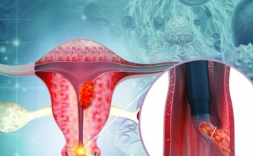 5 SIMPTOMA RAKA GRLIĆA MATERICE: OVO ne smije dase zanemari i čim primijetite odmah se javite ljekaru