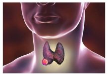 Karcinom štitne žlijezde se najteže otkriva: Ovo su prvi simptomi, ne ignorirajte ih