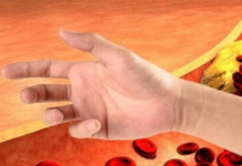 Visoki holesterol može dovesti do moždanog ili srčanog udara: JEDAN SIGNAL NA VAŠIM RUKAMA MOŽE TO ODATI!