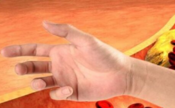 Visoki holesterol može dovesti do moždanog ili srčanog udara: JEDAN SIGNAL NA VAŠIM RUKAMA MOŽE TO ODATI!