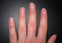 IMATE LI OVAKVE IZBOČINE NA NOKTIMA – evo šta one znače: Doktorica otkrila i možda ćete se iznenaditi IMATE LI OVAKVE IZBOČINE NA NOKTIMA – evo šta one znače: Doktorica otkrila i možda ćete se iznenaditi - featured image