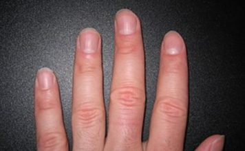 IMATE LI OVAKVE IZBOČINE NA NOKTIMA – evo šta one znače: Doktorica otkrila i možda ćete se iznenaditi IMATE LI OVAKVE IZBOČINE NA NOKTIMA – evo šta one znače: Doktorica otkrila i možda ćete se iznenaditi - featured image