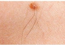 Imate li mladež iz kojeg raste dlaka? Njegovo značenje će vas potpuno iznenaditi! Imate li mladež iz kojeg raste dlaka? Evo šta to znači - featured image