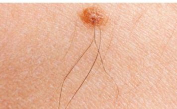 Imate li mladež iz kojeg raste dlaka? Njegovo značenje će vas potpuno iznenaditi! Imate li mladež iz kojeg raste dlaka? Evo šta to znači - featured image