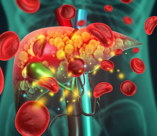 Akutno otkazivanje jetre: 9 simptoma koje ne smete ignorisati – opasno je po život Akutno otkazivanje jetre: 9 simptoma koje ne smete ignorisati – opasno je po život - featured image