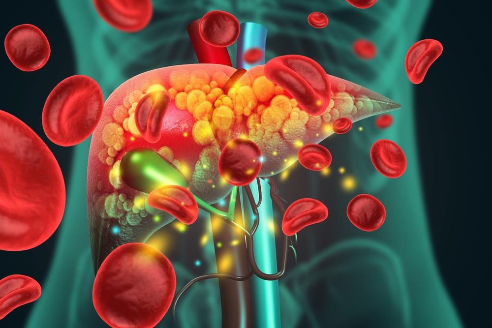 Akutno otkazivanje jetre: 9 simptoma koje ne smete ignorisati – opasno je po život - featured image Akutno otkazivanje jetre: 9 simptoma koje ne smete ignorisati – opasno je po život - featured image