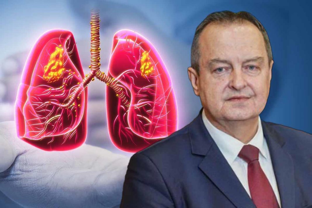 Simptomi obostrane upale pluća zbog koje je Ivica Dačić na respiratoru: Što je više režnjeva zahvaćeno, komplikacije su veće - featured image Simptomi obostrane upale pluća zbog koje je Ivica Dačić na respiratoru: Što je više režnjeva zahvaćeno, komplikacije su veće - featured image