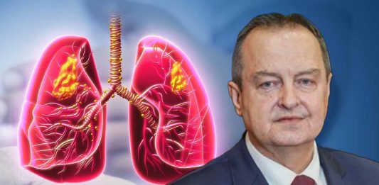 Simptomi obostrane upale pluća zbog koje je Ivica Dačić na respiratoru: Što je više režnjeva zahvaćeno, komplikacije su veće Simptomi obostrane upale pluća zbog koje je Ivica Dačić na respiratoru: Što je više režnjeva zahvaćeno, komplikacije su veće - featured image