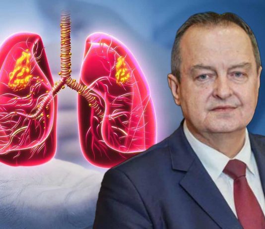 Simptomi obostrane upale pluća zbog koje je Ivica Dačić na respiratoru: Što je više režnjeva zahvaćeno, komplikacije su veće Simptomi obostrane upale pluća zbog koje je Ivica Dačić na respiratoru: Što je više režnjeva zahvaćeno, komplikacije su veće - featured image