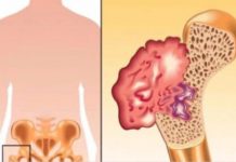 Ako osjetite bolove u kostima, visoki krvni tlak i osjećaj tuge, to može ukazivati na nedostatak ovog ključnog vitamina Ako osjetite bolove u kostima, visoki krvni tlak i osjećaj tuge, to može ukazivati na nedostatak ovog ključnog vitamina - featured image