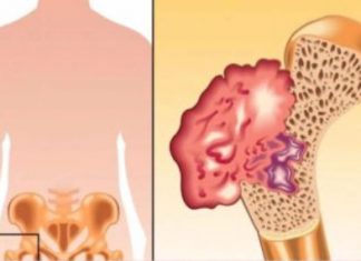 Ako osjetite bolove u kostima, visoki krvni tlak i osjećaj tuge, to može ukazivati na nedostatak ovog ključnog vitamina Ako osjetite bolove u kostima, visoki krvni tlak i osjećaj tuge, to može ukazivati na nedostatak ovog ključnog vitamina - featured image