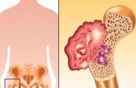 Ako osjetite bolove u kostima, visoki krvni tlak i osjećaj tuge, to može ukazivati na nedostatak ovog ključnog vitamina Ako osjetite bolove u kostima, visoki krvni tlak i osjećaj tuge, to može ukazivati na nedostatak ovog ključnog vitamina - featured image